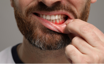 Gengive arrossate: cause, rimedi e come trattarle