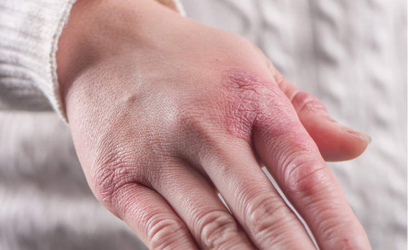 Come prevenire e trattare i geloni in inverno