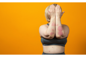 Psoriasi: comprendere questa condizione cutanea e gestire i sintomi