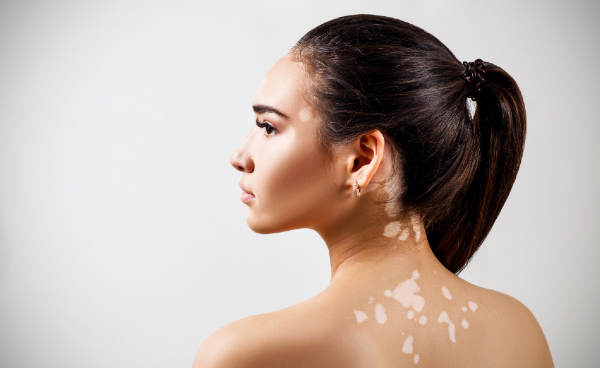 Vitiligine: come inizia e come si cura