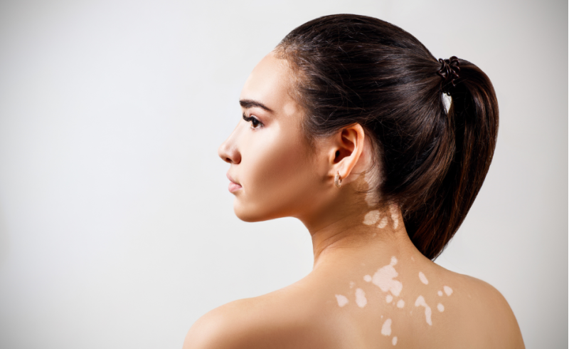 Vitiligine: come inizia e come si cura