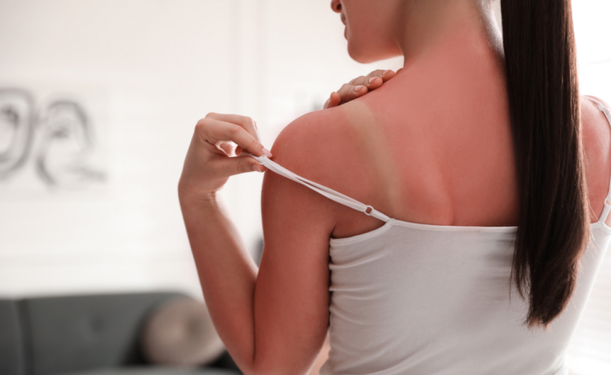 Scottature solari: cosa fare per lenire la pelle Scottature solari: cosa fare per lenire la pelle