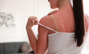 Scottature solari: cosa fare per lenire la pelle