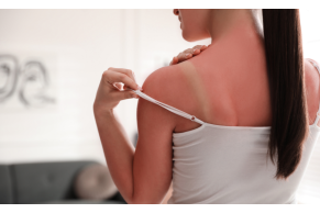 Scottature solari: cosa fare per lenire la pelle